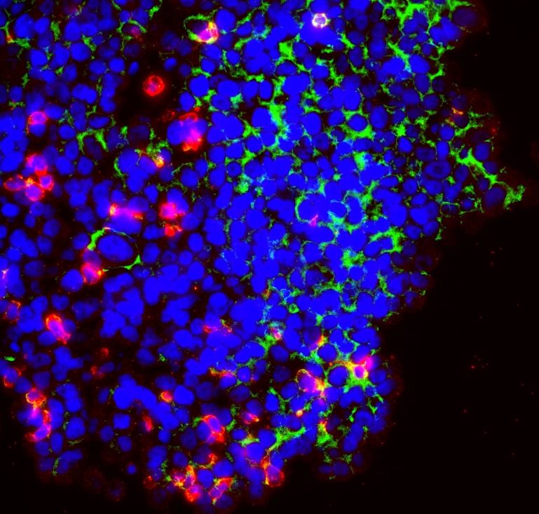 T cells marked in red and blue infiltrate a blue cancer-cell spheroid.